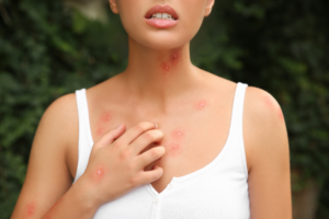 woman covered in ant bites